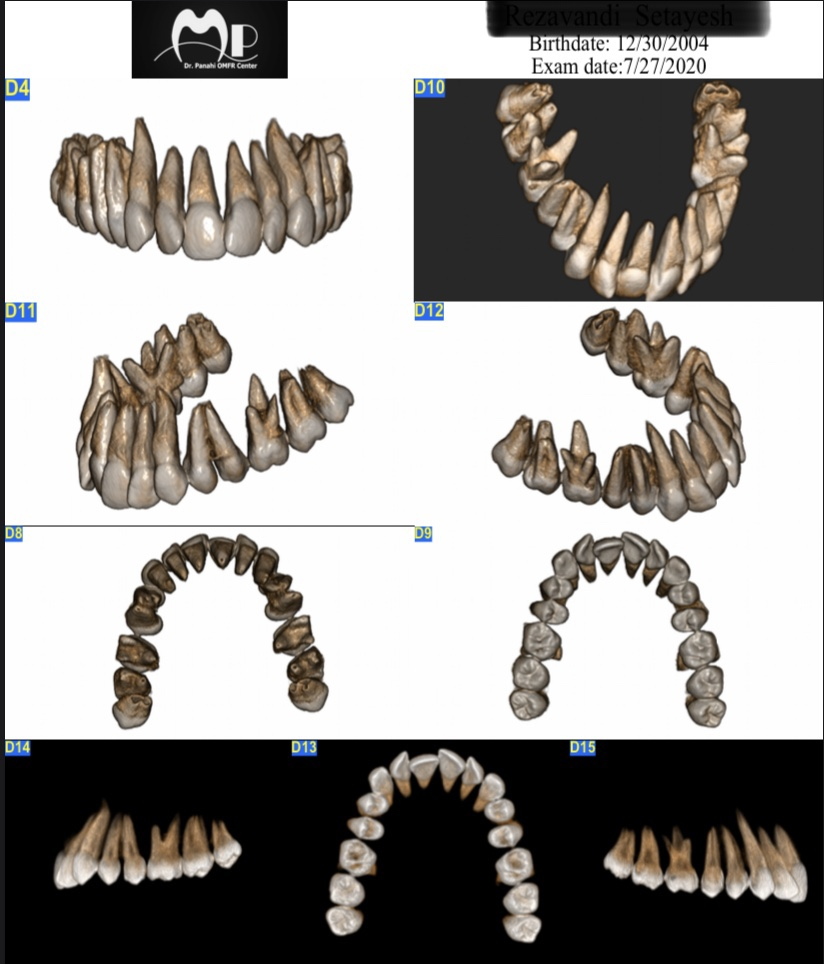 نمونه اي از تصاوير سي تي اسكن دندان با نماي isolated tooth view 